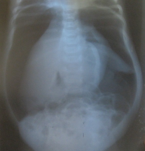 pneumo-peritoneum